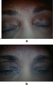 Physicians think xanthelasma appears when the connection in between specific cells inside your. Argon Laser Versus Erbium Yag Laser In The Treatment Of Xanthelasma Palpebrarum Sciencedirect