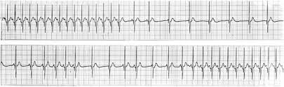 Sick Sinus Syndrome Springerlink