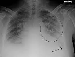 Image result for Transfusion Associated Circulatory Overload