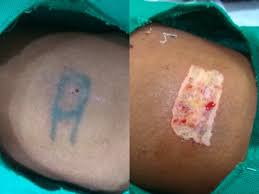 Some small tattoos might be good candidates for surgical removal, while others are considered too large to remove with a scalpel. Cosmetic Surgery For Permanent Tattoo Removal Dr Agarwal S Clinic