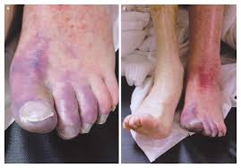 Image result for flegmona pedis)