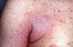 Image result for scabies human bites