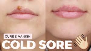 how to cure a cold sore fast healed
