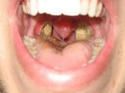 Maybe you would like to learn more about one of these? Swollen Uvula Causes It Is Possible Lucas Dental Care Facebook