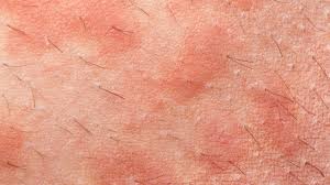 Image result for Atopic eczema atopic dermatitis