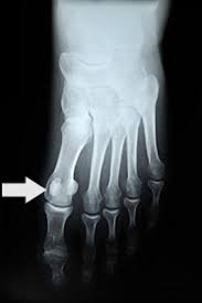 Pin On Foot Pain