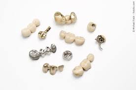 Dazu entfernt der zahnarzt zunächst das provisorium und setzt die krone ohne fixierung auf den beschliffenen zahnstumpf. Wie Lange Halten Kronen Und Brucken Wissenswertes Zahnersatzsparen De