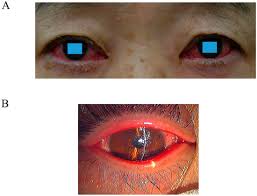 Image result for Viral Conjunctivitis