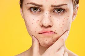 Jerawat pasir atau bruntusan adalah jerawat yang ditandai dengan bintil kecil yang belum berkembang atau biasa disebut comedonal acne. Apa Itu Jerawat Pasir Penyebab Dan Cara Pencegahannya