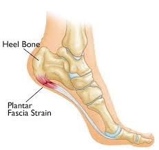 Plantar fasciitis is usually worst first thing in the morning when you get out of bed, eases of as you walk around and then returns after you have been on your feet for a while. Plantar Fasciitis And Bone Spurs Orthoinfo Aaos