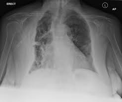 Maybe you would like to learn more about one of these? Malignant Pleural Mesothelioma Radiology Case Radiopaedia Org