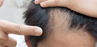Treatments for hair loss include medications and surgery. How To Stop Hair Loss Clinicexpert International