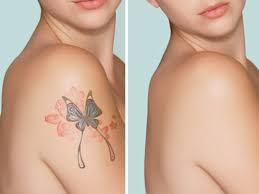 But when tattooing over a mole, it's a different story. The Cosmetic Vein Laser Center Laser Tattoo Removal
