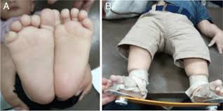 We did not find results for: The Foot External Rotation Above Knee Ferak Brace Versus The Denis Browne Brace For Management Of Idiopathic Clubfoot Following Ponseti Casting A Randomized Controlled Trial Springerlink