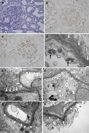 It was first identified in december 2019 in wuhan,. Relapse Of Class V Lupus Nephritis After Vaccination With Covid 19 Mrna Vaccine Kidney International