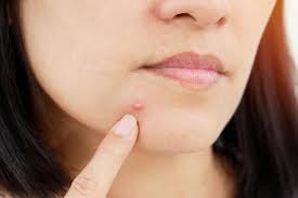 Just remember i am in no way shape or form a doctor of any sort. 7 Different Types Of Acne Explained