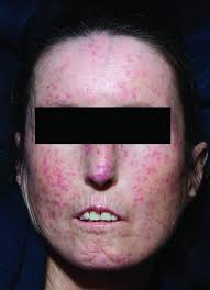 Systemic sclerosis – the dermatological perspective - Sticherling - 2019 -  JDDG: Journal der Deutschen Dermatologischen Gesellschaft - Wiley Online  Library