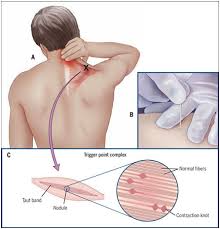 trigger point dry needling physical therapy arlington