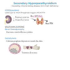 Image result for Hyperparathyroidism