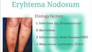 Image result for erythema nodosum
