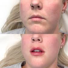 Lip Fillers