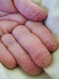 Proven Natural Home Remedies For Dry Cracked Hands Diy Dry Cracked Skin Health And Beauty Tips Natural Home Remedies