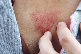 We did not find results for: Awas Pityriasis Rosea Sebabkan Ruam Sebesar Koin Dan Bersisik