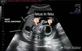 A Gallery Of High Resolution Ultrasound Color Doppler 3d Images Fetal Abdomen