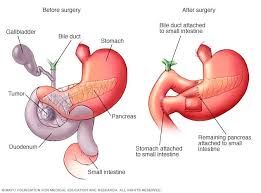 It helps you digest your food and makes hormones, such as insulin. Surgery For Pancreatic Cancer Overview