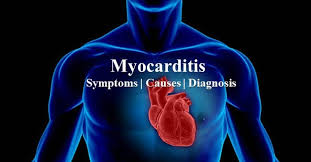 In many cases, individuals experience no. Myocarditis Causes Symptoms And Diagnosis Dr Sarat