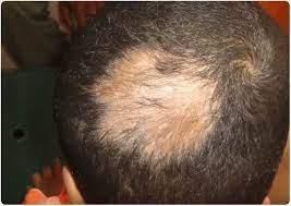 Usually, burrow's solution is quite helpful for this. What Is Folliculitis Decalvans