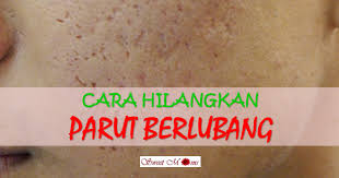 Nak tahu tak cara cepat dan berkesan untuk hilangkannya? Sweet Moms Vitamin Cantik Dan Sihat Dengan Vitamin Semulajadi Shaklee Cara Hilangkan Parut Jerawat Berlubang Dengan Mudah Dan Berkesan