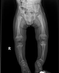 Image result for Rickets