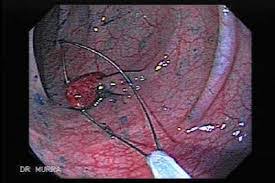 Tarmudrensningsmidlet er en saltopløsning, man skal drikke både dagen før og om morgenen inden. Fjernelse Af Tarmpolypper