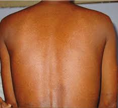 Image result for Diffuse Hyperpigmentation