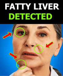 MOST PEOPLE DON'T KNOW THE 4 SIGNS OF FATTY LIVER DISEASE