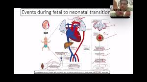 Image result for Delayed Transition from Fetal Circulation