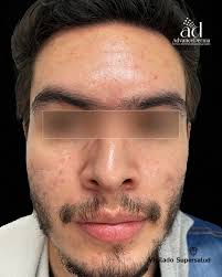 Tratamientos para Dermatitis en Bogotá