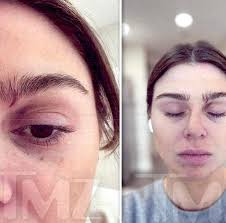 Raquel's eye after being punched! : r/realhousewives