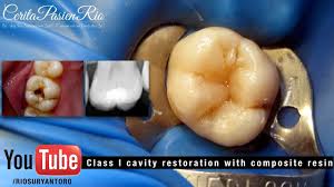 Perawatan Gigi Tambalan Resin Komposit Di Bagian Oklusal Spesialis Konservasi Gigi Youtube