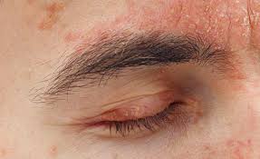 Image result for psoriasis