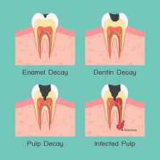 Symptoms Of An Abscessed Tooth - Duff Family Dental