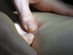 Both bot flies are removed using a tweaser. The Tale Of Tiny Tim Noah Strycker