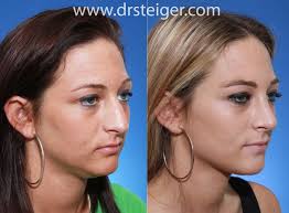 Each case demonstrates different results and interventions to help patients to see different cases. Rhinoplasty Before And After Photos