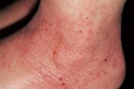 Image result for Atopic eczema atopic dermatitis