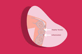 4 Faktor Risiko Tingkatkan Osgood Schlatter Disease