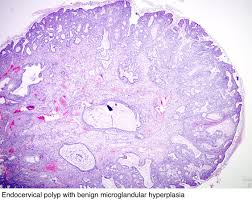 Pathology Outlines Endocervical Polyp