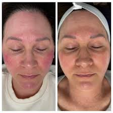 Before and after one BBL ⚡️