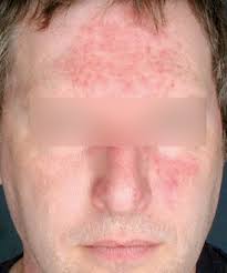Rosacea
