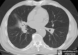 Image result for Broncholithiasis
